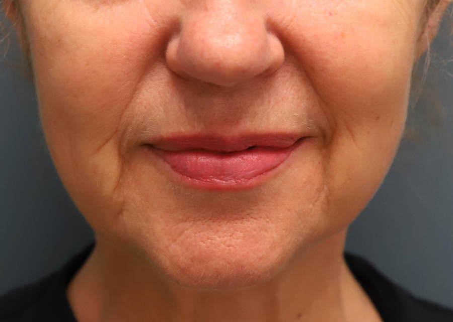 Ellacor Skin Rejuvenation Before Photo