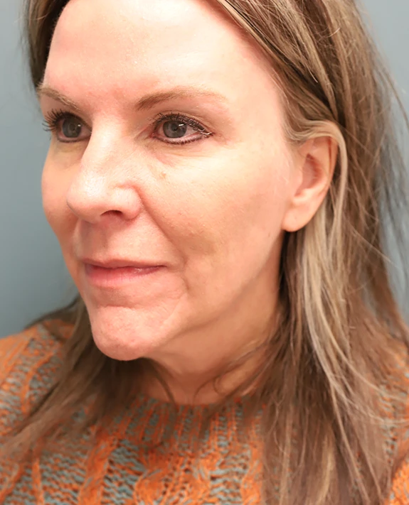 Brow Lift + Blepharoplasty After Photo