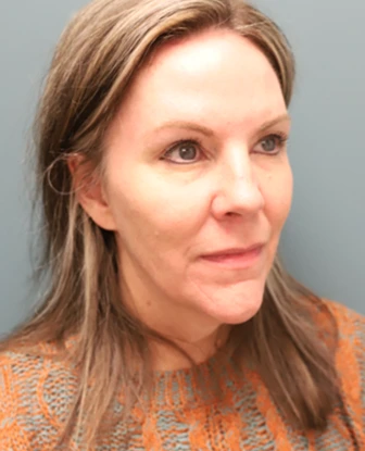 Brow Lift + Blepharoplasty After Photo