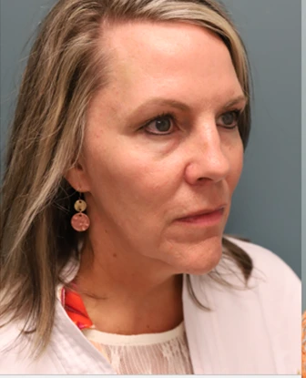 Brow Lift + Blepharoplasty Before Photo