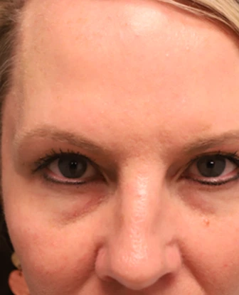 Brow Lift + Blepharoplasty Before Photo