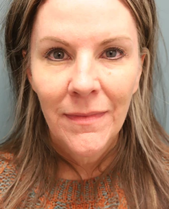 Brow Lift + Blepharoplasty After Photo