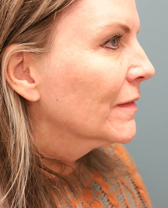 Brow Lift + Blepharoplasty After Photo