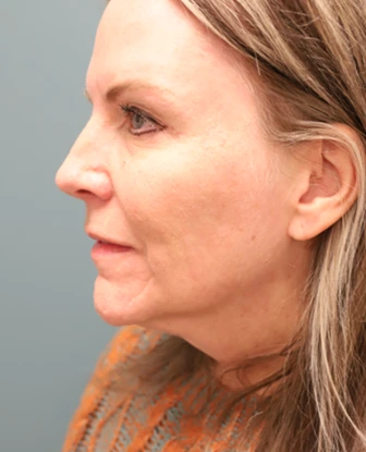 Brow Lift + Blepharoplasty After Photo