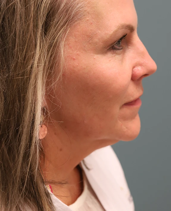 Brow Lift + Blepharoplasty Before Photo