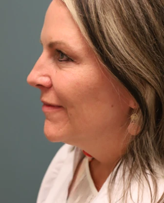 Brow Lift + Blepharoplasty Before Photo