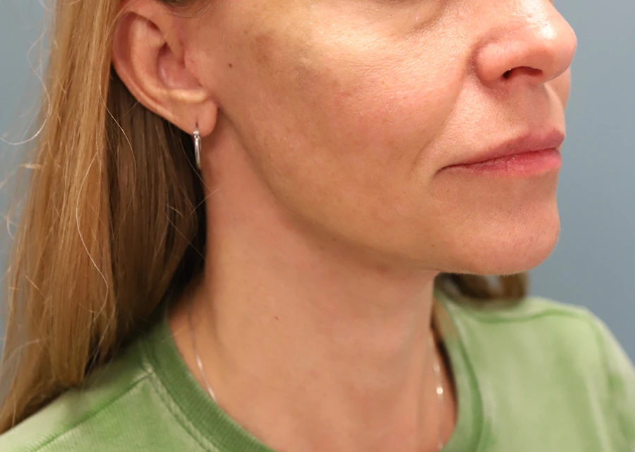 Facelift + Fat Grafting After Photo