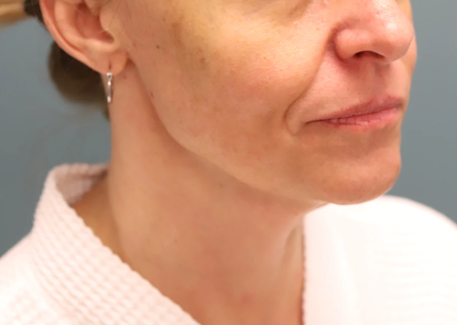 Facelift + Fat Grafting Before Photo