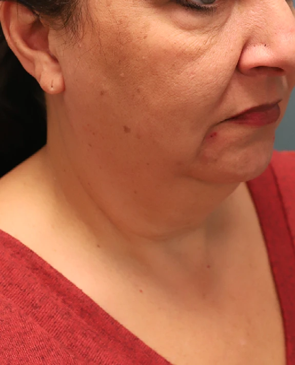 Neck Lift Before Photo