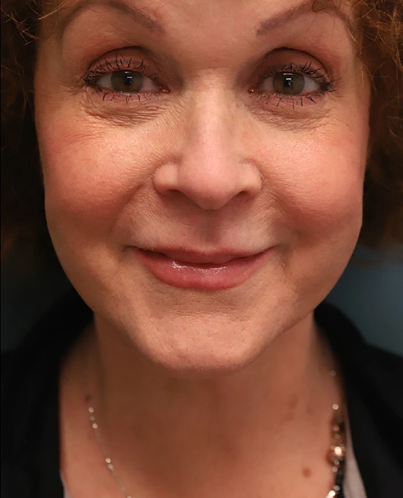 Neck Lift After Photo