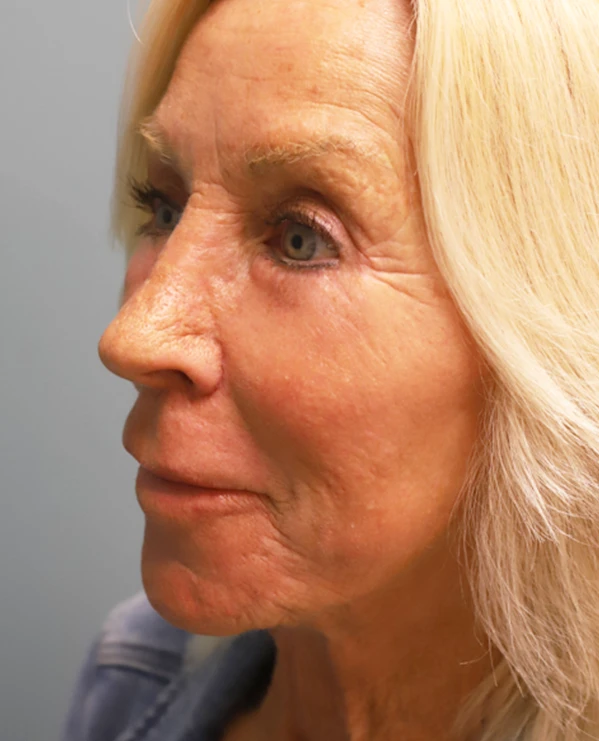 Blepharoplasty + Fat Grafting After Photo