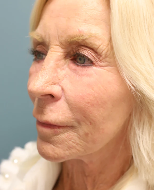 Blepharoplasty + Fat Grafting Before Photo