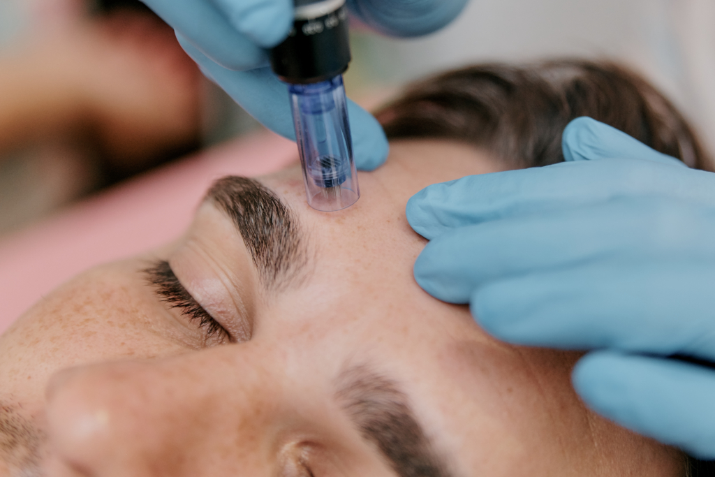 Procedure of induction therapy with microneedles and collagen on the face of a man