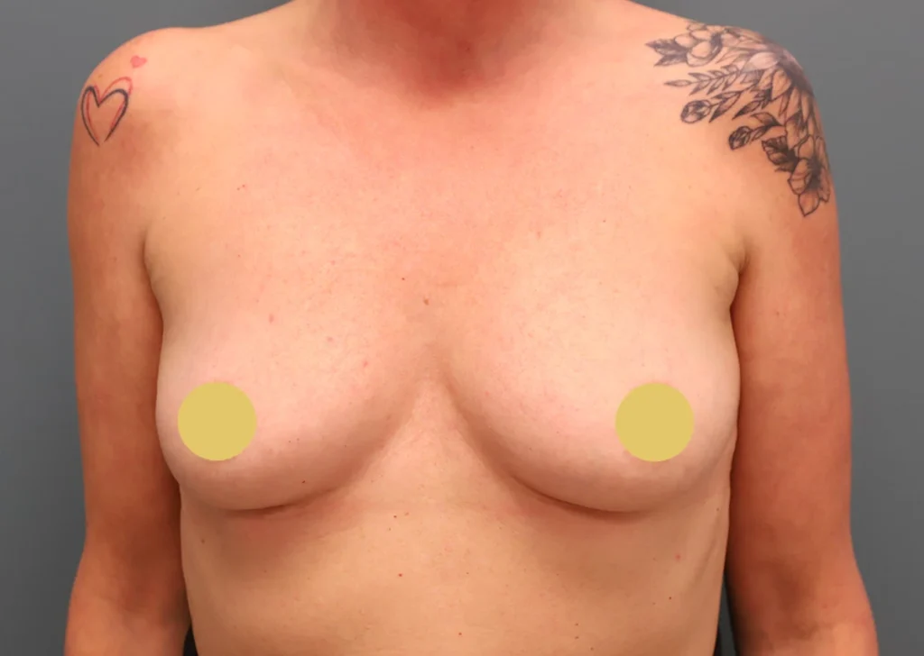 Breast Augmentation Before Photo