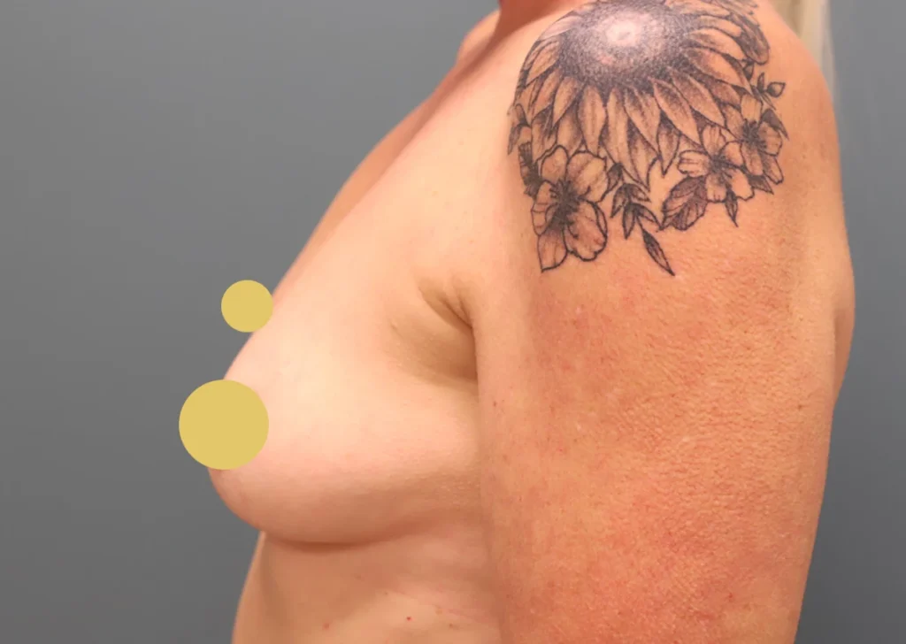 Breast Augmentation Before Photo